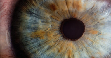 Fabry, eye differences