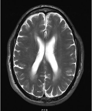 white matter | Fabry Disease News | An MRI scan of Jerry's brain shows white matter lesions that have grown in size since his last scan.