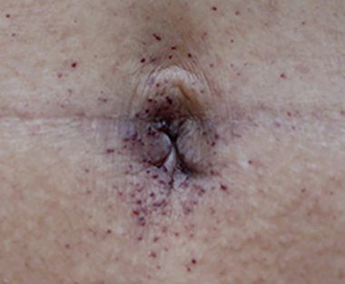 Fabry disease awareness | Fabry Disease News | A close-up photo of Jerry's navel, which shows dozens of small purplish dots called angiokeratoma.
