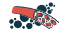 A close-up illustration provides an inside view of a blood vessel.