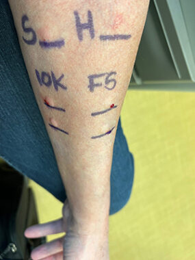 The photo shows a close-up of a man's left forearm. He's undergoing allergy testing, so there are various marks and welts indicating what he's allergic to.