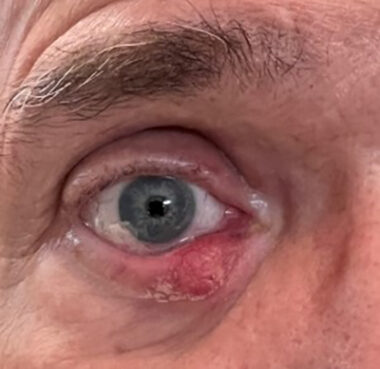 A stye (red bump with fluid and swelling) appears on the lower eyelid of a man's right eye. 