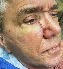 A man's face in close-up, with a row of red stitches beside his nose where he had basal cell carcinoma removed.