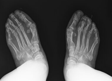 An X-ray of a man's feet reveals toe dislocation. 